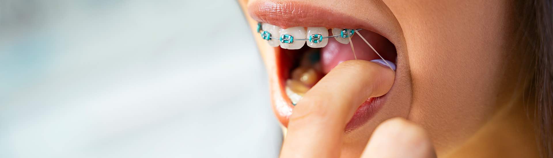 Czym są wyciągi ortodontyczne?