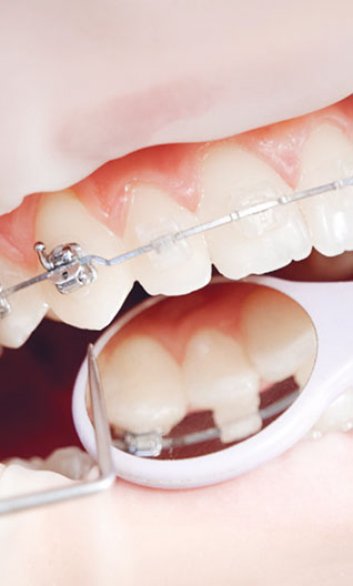 Fragment łuku zębowego pacjenta z widocznym stałym aparatem ortodontycznym