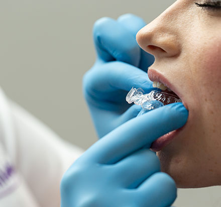 Dwie dłonie w niebieskich jednorazowych rękawiczkach nakładają na zęby pacjentki przezroczystą nakładkę prostującą 1