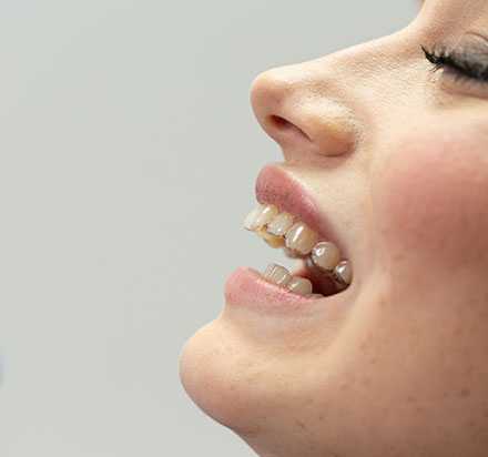Widok na profil twarzy pacjentki z nałożoną na górny łuk zębowy ortodontyczną nakładką prostującą 1