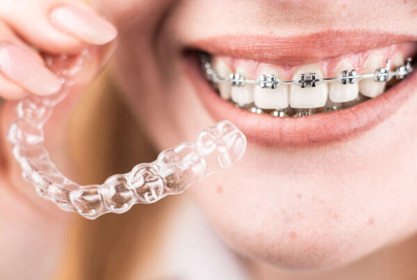Uśmiech proste zęby aparat ortodontyczny stały nakładki ortodontyczne przezroczyste