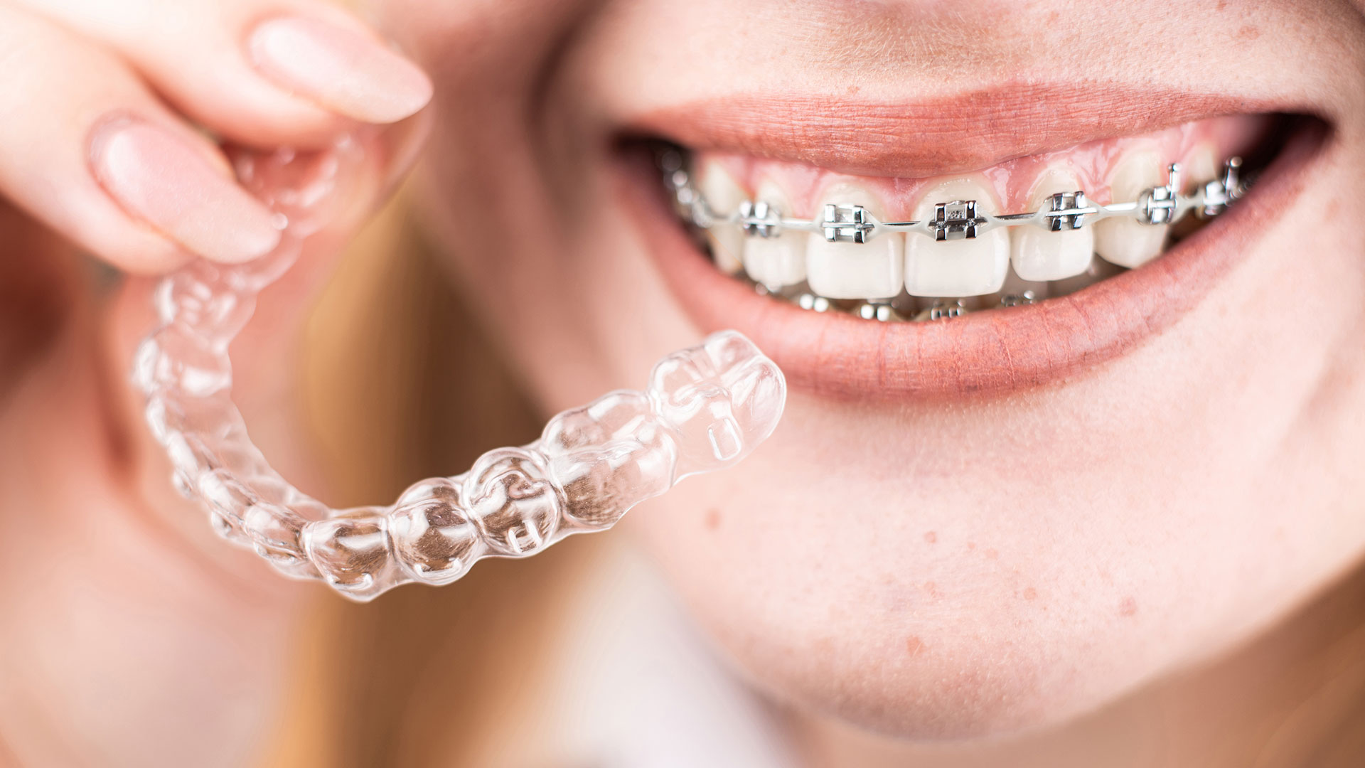 Uśmiech proste zęby aparat ortodontyczny stały nakładki ortodontyczne przezroczyste