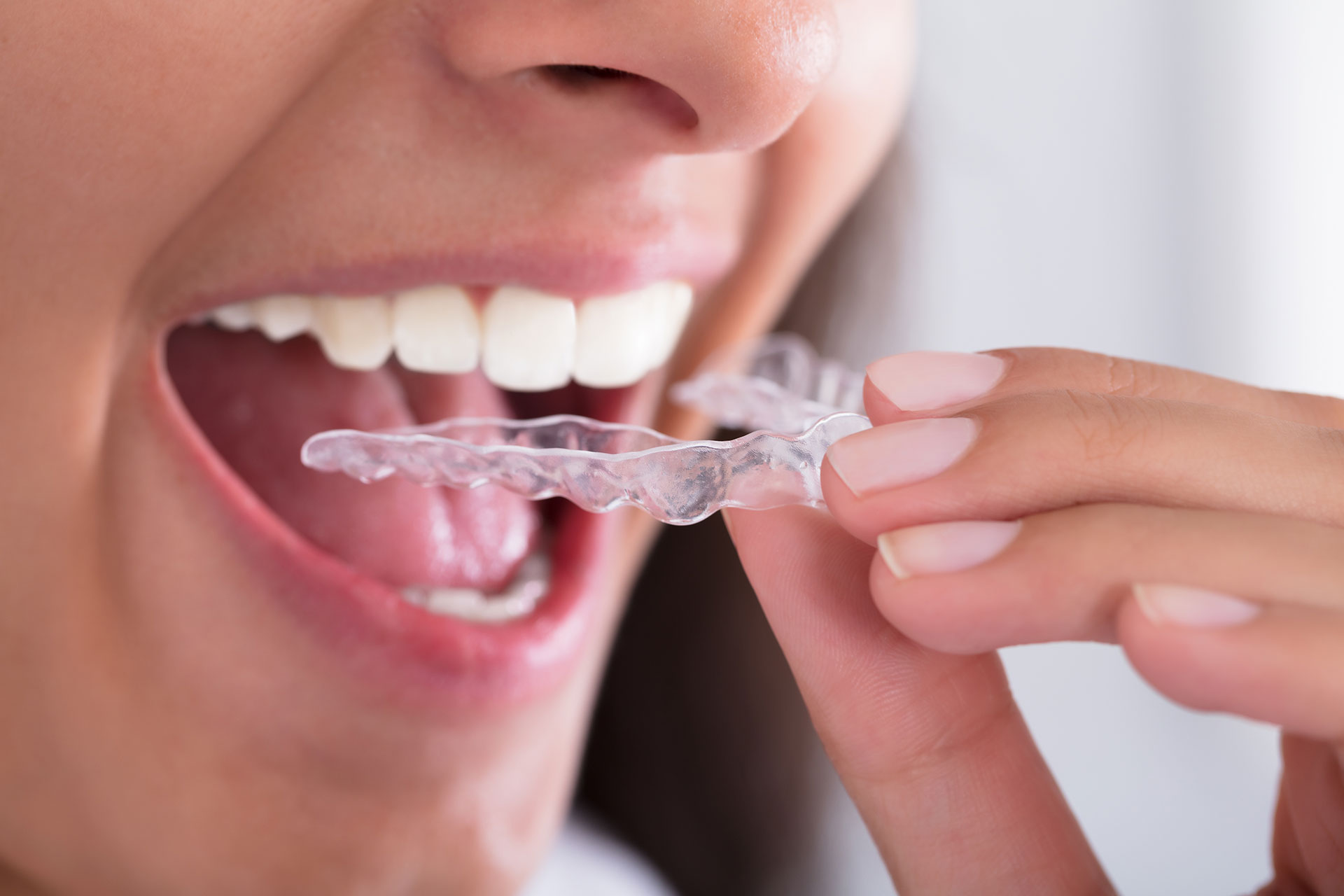 Usta zęby i ręka trzymająca przezroczystą nakładkę ortodontyczną 6